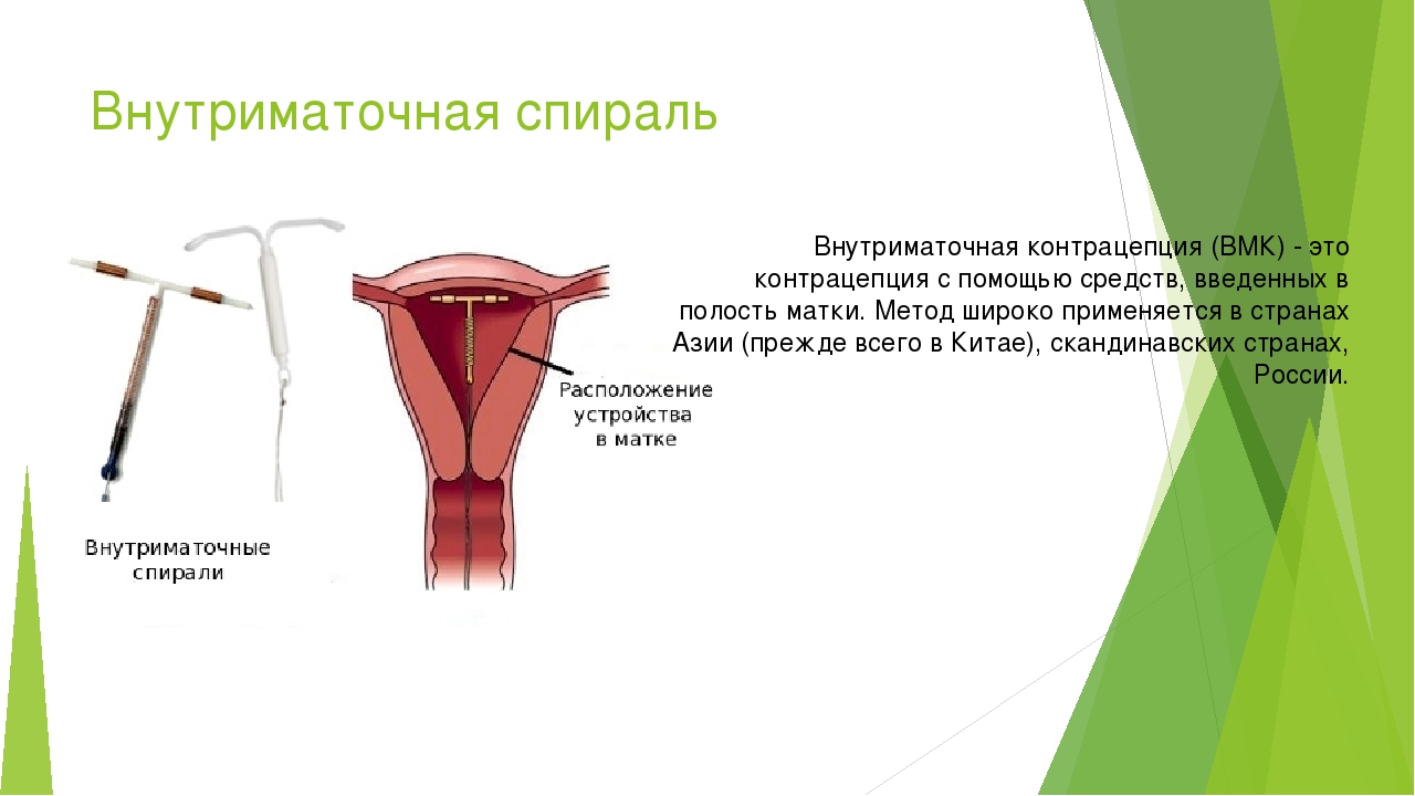 Вмс это. Спираль внутриматочная принцип действия. Внутриматочная спираль метод контрацепции. Противозачаточная спираль принцип действия. Маточная спираль принцип действия.