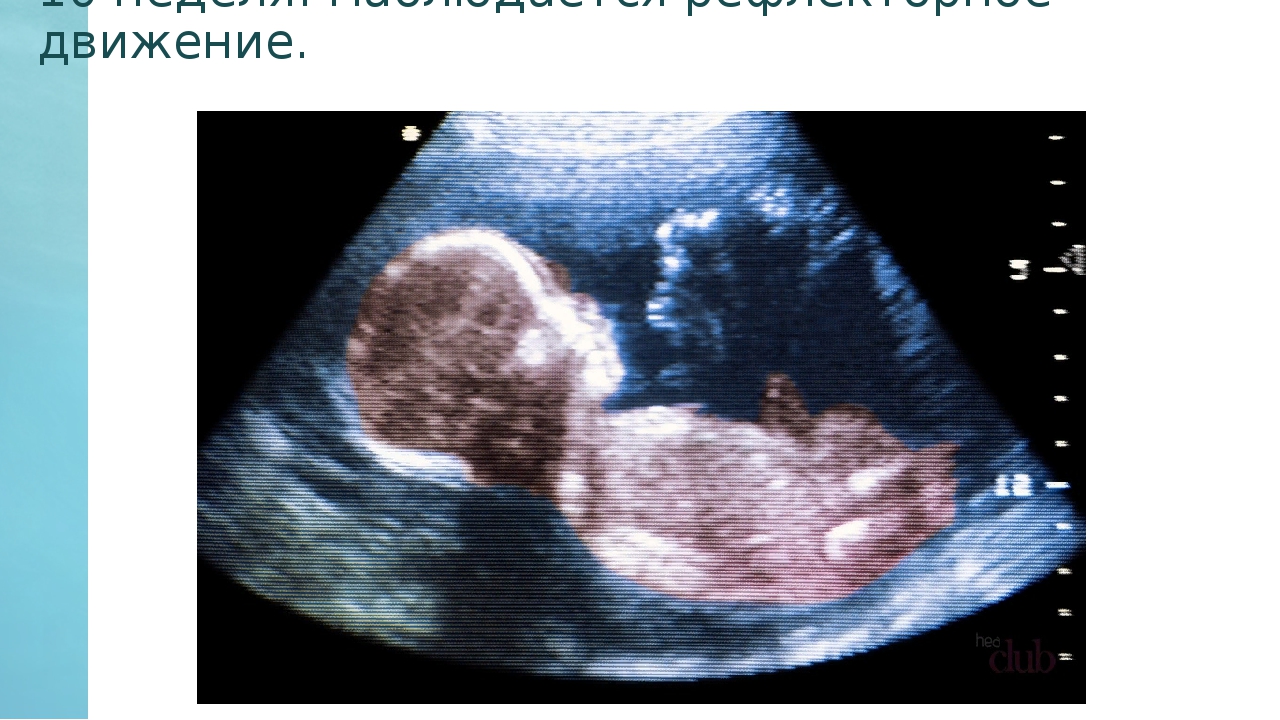 УЗИ беременности 3 скрининг