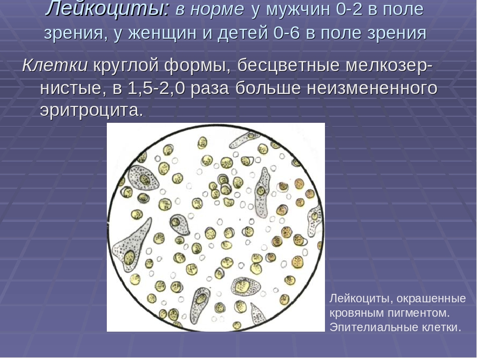 Эритроциты и лейкоциты в моче у мужчин. Лейкоциты в моче микроскопия осадка. Микроскопия мочи лейкоциты. Лейкоциты при микроскопия мочи. Лейкоциты в моче 2 тире 4.