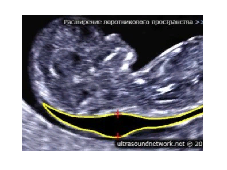 Воротниковое пространство. Воротниковая зона норма УЗИ. УЗИ норма ТВП 12 недель беременности. УЗИ плода толщина воротникового пространства. На УЗИ расширение ТВП.