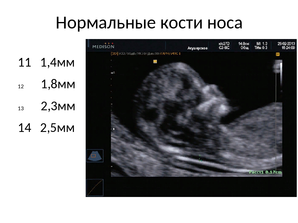 Норма плода 13 недель. Носовая кость УЗИ плода в 12 недель норма. Носовая кость в 12 недель при синдроме Дауна. 13 Недель беременности носовая кость 1,5 мм. Носовая кость плода в 20 недель на УЗИ.