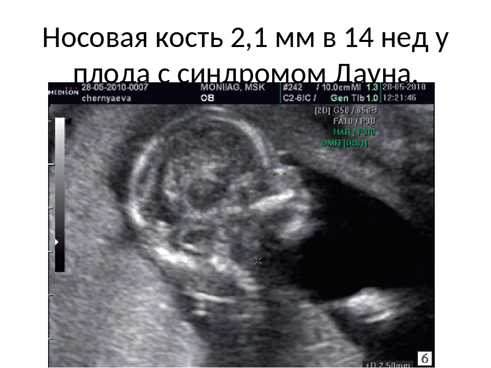Кости в 13 недель. УЗИ носовой кости плода на 12 неделе беременности. УЗИ 20 недель беременности носовая кость. УЗИ 13 недель беременности носовая кость. Гипоплазия носовой кости у плода 12 -13 недель беременности.