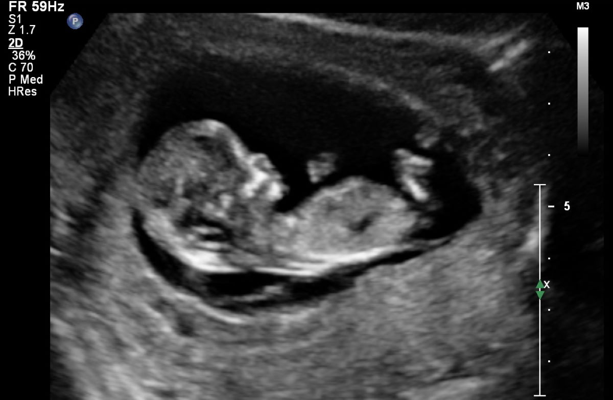 Десятка недели. УЗИ ребенка на 10 неделе беременности. УЗИ плода на 10 неделе беременности. 10 Недель беременности фото плода на УЗИ. Снимок УЗИ на 10 неделе беременности.