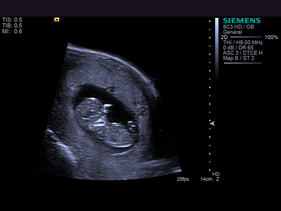 10 неделя 2024г. Плод 10 недель беременности фото размер плода. Эмбрион 10 недель беременности размер плода фото. Эмбрион на 10 неделе беременности УЗИ. Как выглядит эмбрион в 10 недель на УЗИ.