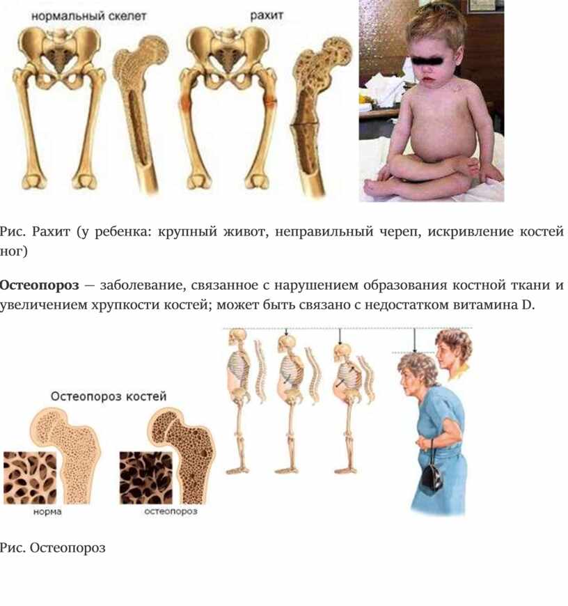 Кости 8 месяцев. Рахит деформация костей. Укорочение трубчатых костей при рахите. Искривление костей у ребенка.