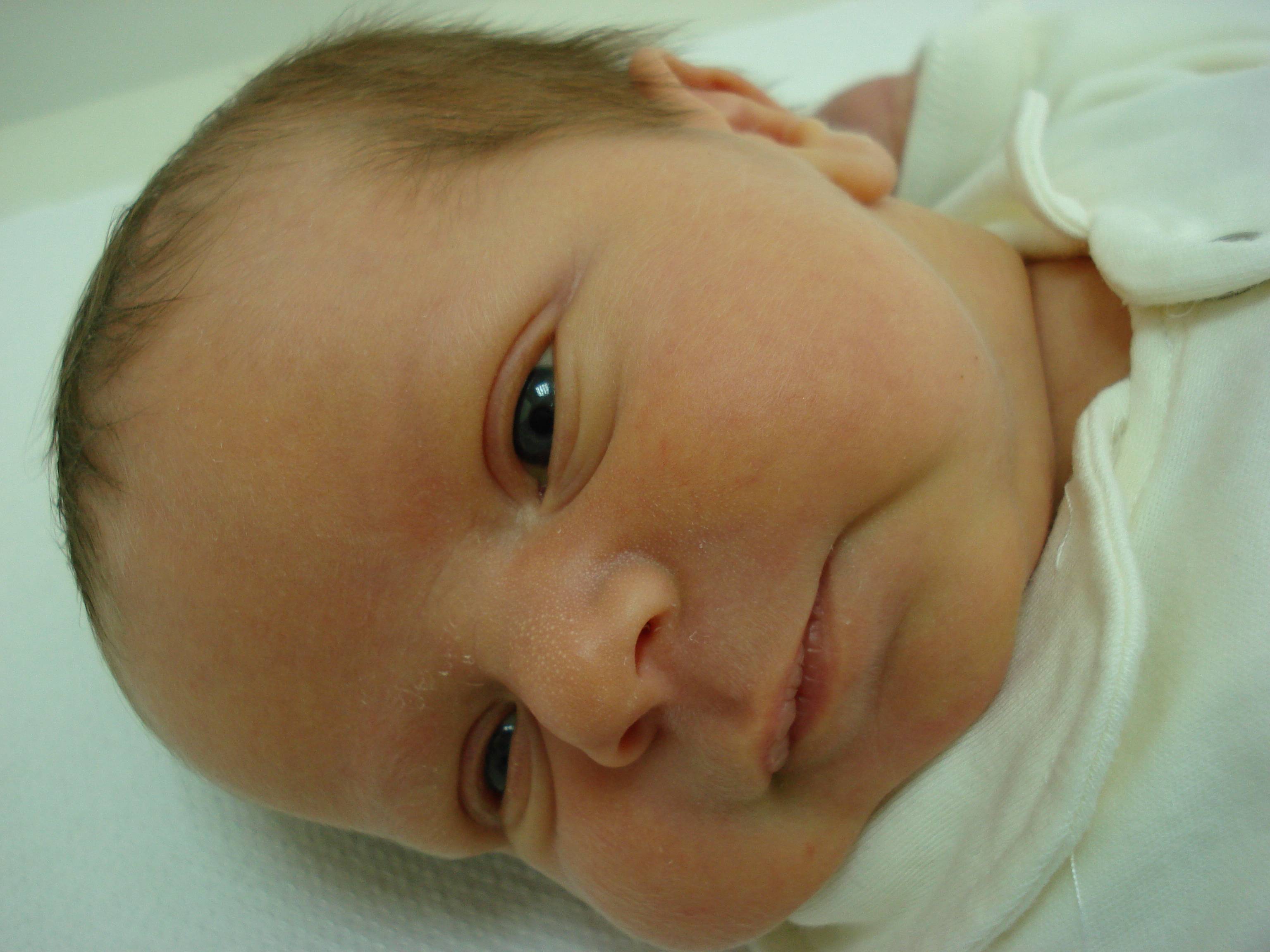 Желтушка у младенцев фото