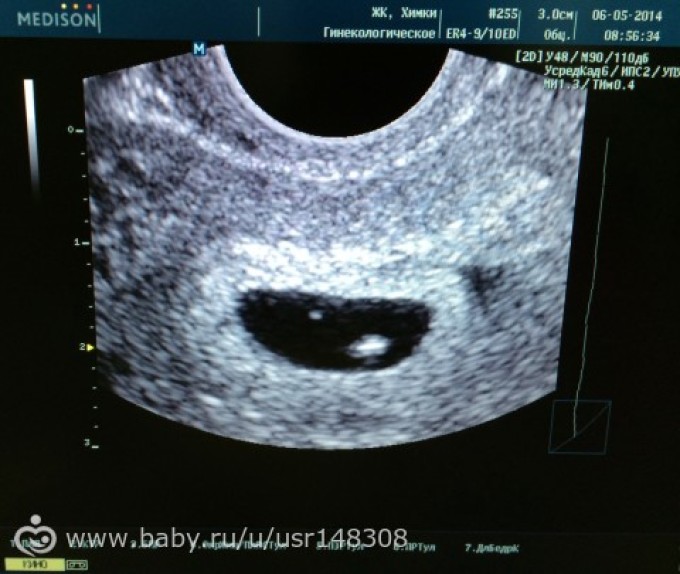 Беременность 5 недель можно. Анэмбриония  6,5 недель беременности. УЗИ 8 недель беременности анэмбриония. Анэмбриония – пустое плодное яйцо.