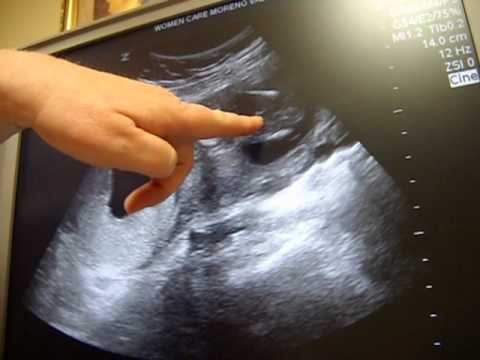 16 недель беременности можно узнать пол. Пол ребенка на УЗИ. Пол на УЗИ. УЗИ беременности девочка.