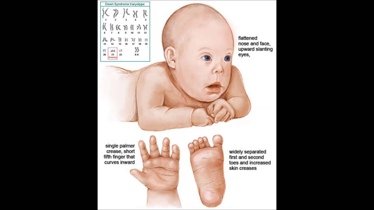 Синдром дауна лишняя хромосома. Синдром Дауна трисомия 21 хромосомы. Синдром Дауна трисомия 21. Трисомия 21 хромосомы дети. Синдром Патау (трисомия 13-й хромосомы).