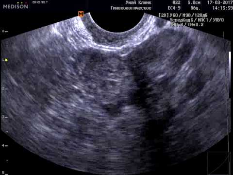 На узи видно внематочную. Внематочная беременность фото. Внематочная беременность видеофильм операции. Внематочная беременность на УЗИ фото. Внематочная беременность фото после операции.
