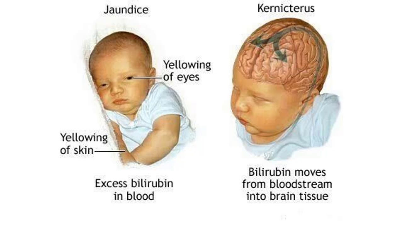 Желтушка у новорожденных билирубин