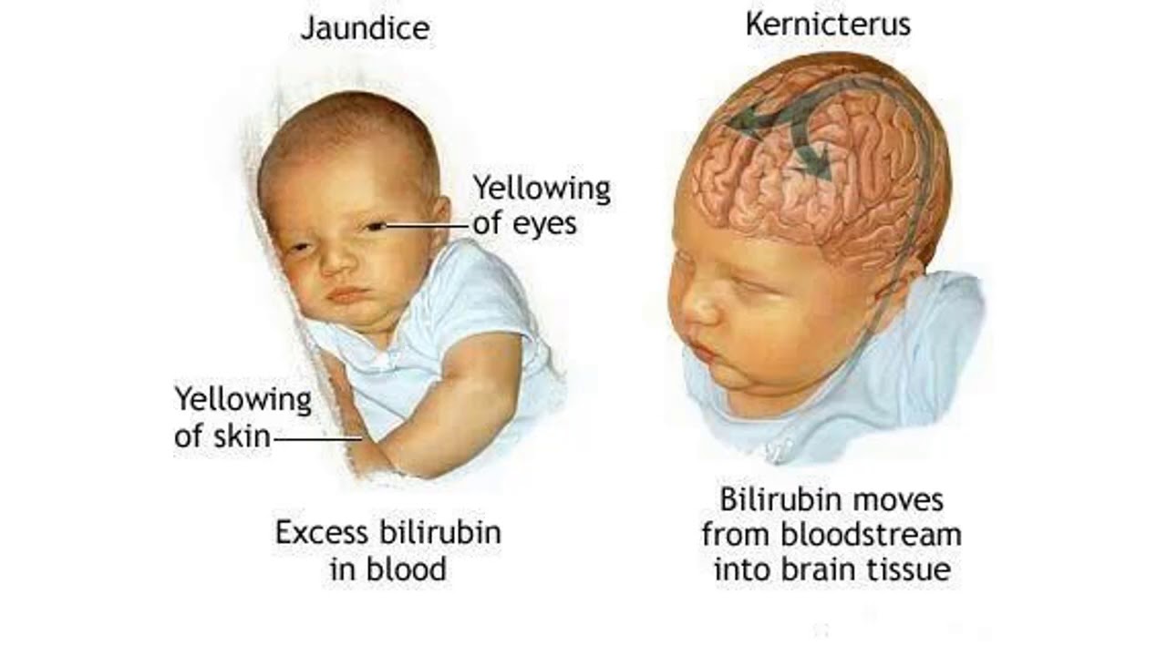 Ребенок желтуха почему. Желтушка у новорожденных. Показатели желтухи у новорожденных. От чего желтушка у новорожденных.