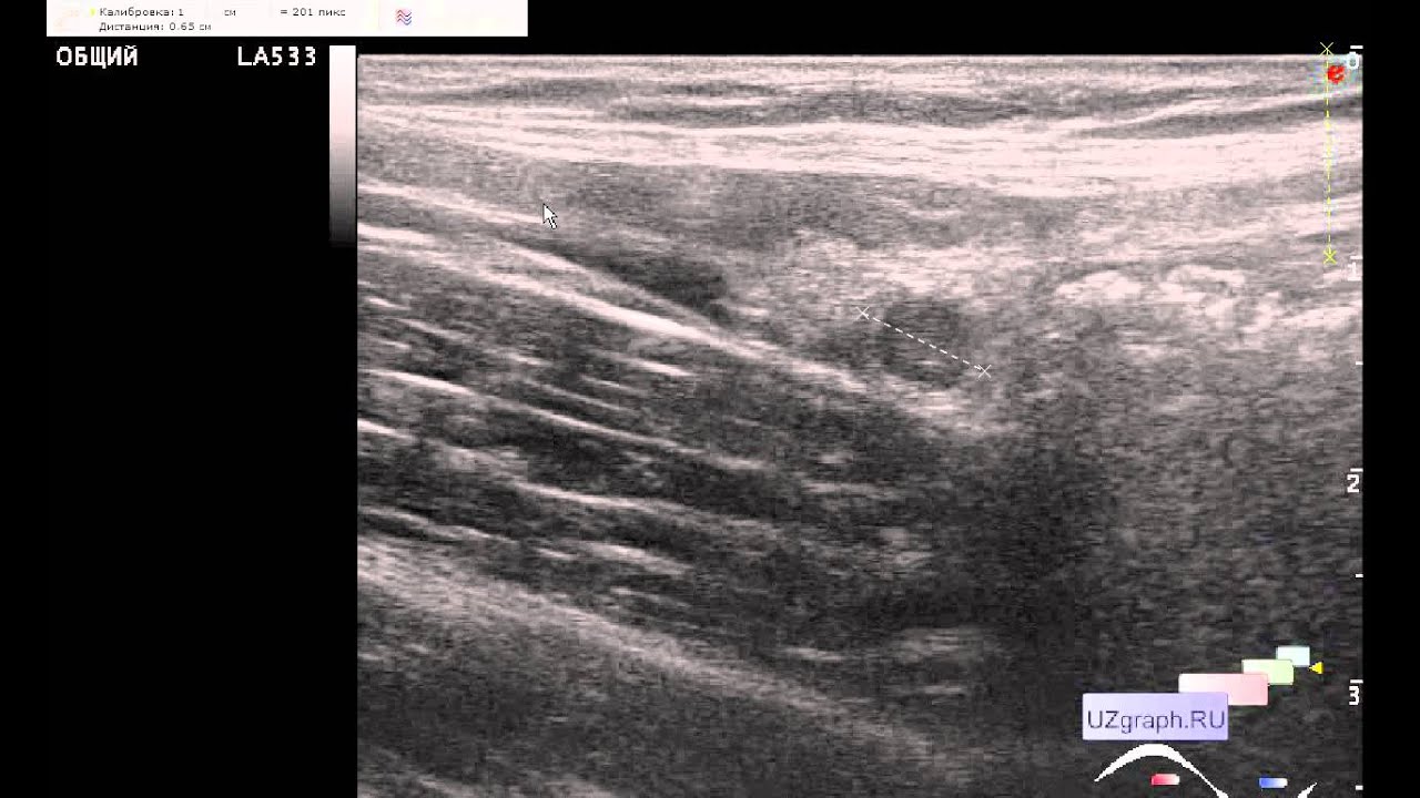 Врач узи обучение ultrasonicthyroid ru. Разрыв икроножной мышцы на УЗИ фото. Гиперэхогенные кишечники на УЗИ. Фото снимок УЗИ желудок. Клинический случай ультразвуковая диагностика.