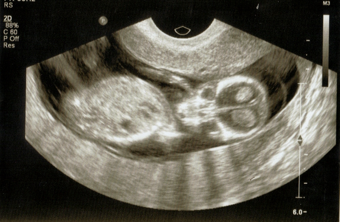 Фото узи ребенка на 14 неделе беременности фото
