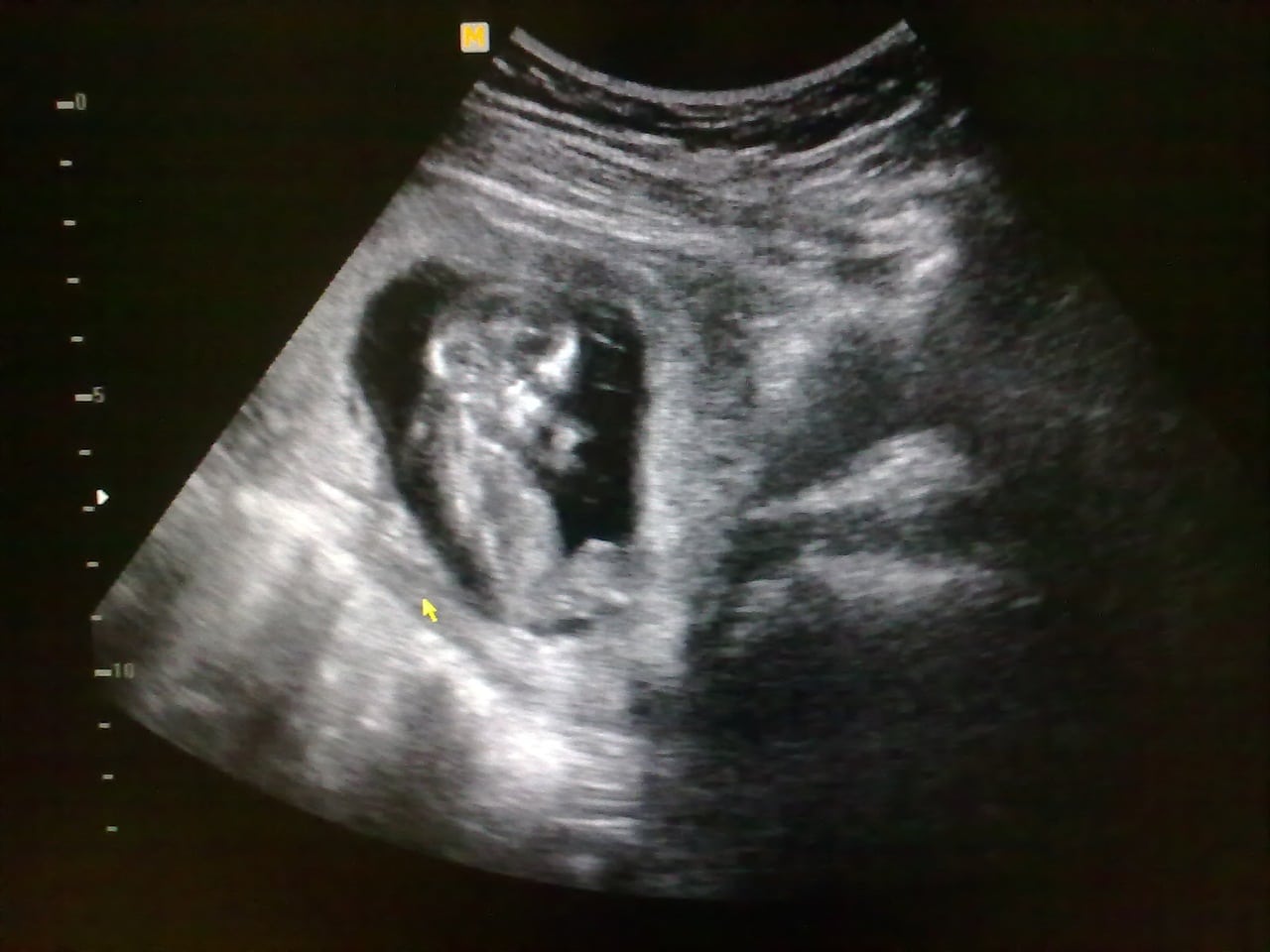 13 недель назад. Эмбрион на 13 неделе беременности. УЗИ плода на 13 неделе беременности. Эмбрион 13 недель беременности фото. 13 Недель беременности фото плода на УЗИ.