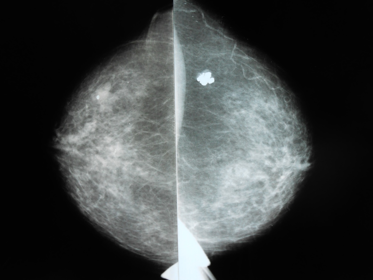 Шишка в грудной железе у женщин. Маммограмма фиброаденома. Фиброаденоз маммография. Фиброма молочной железы. Фиброзно кистозная мастопатия маммограмма.