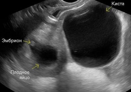 Тянет яичник при беременности на ранних. Фолликулярная киста яичника на УЗИ.