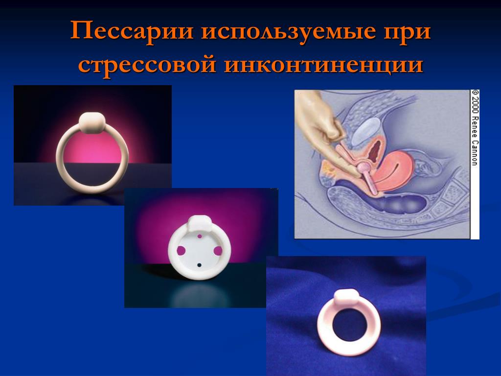 Что за кольцо ставят при беременности на шейку матки