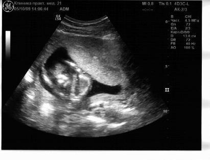 16 недель 3 5. УЗИ ребенка на 16 неделе беременности. Снимок УЗИ на 16 неделе беременности.