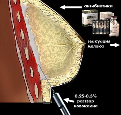 Мастита груди. Консервативная терапия мастита. Нелактационный мастит. Гнойный лактационный мастит.