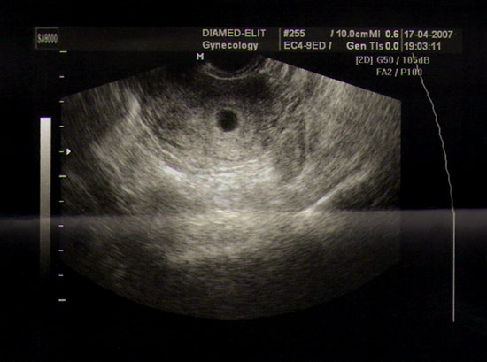 Пять недель беременности фото плода узи