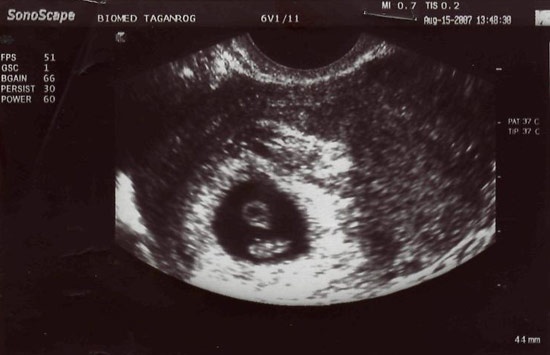 Масса 6 недель. Снимок УЗИ на 6 неделе беременности. УЗИ 5-6 недель беременности.