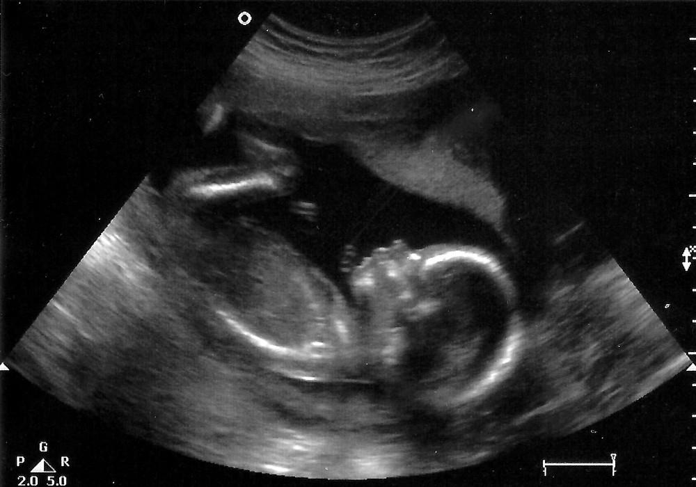 19 недель воды. УЗИ ребенка на 19 неделе беременности. УЗИ плод ребенка 19 недель беременности. УЗИ плода на 19 неделе беременности. Эмбрион на 19 неделе беременности УЗИ.