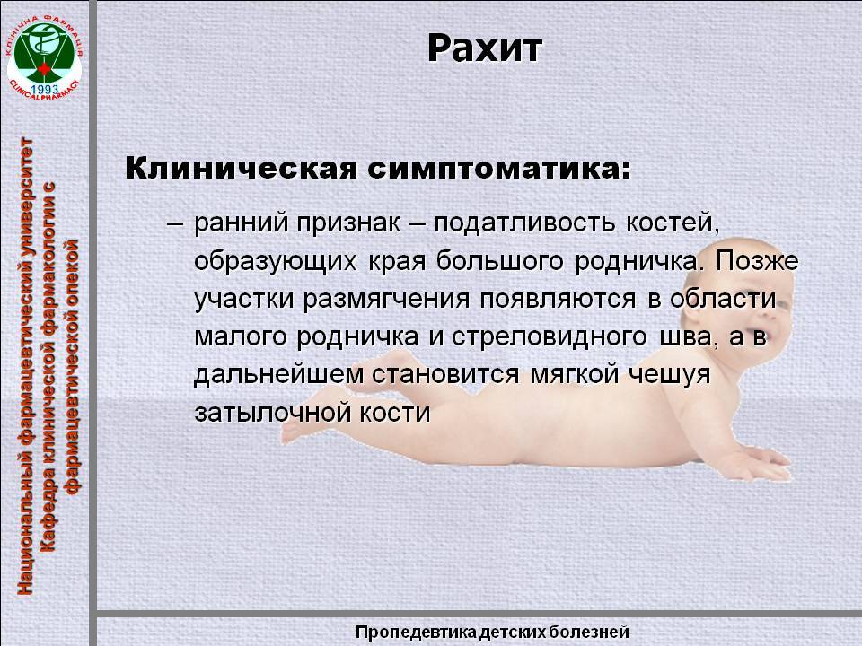 Рахит признаки. Клинические проявления рахита. Клинические признаки рахита. План обследования при рахите у детей.