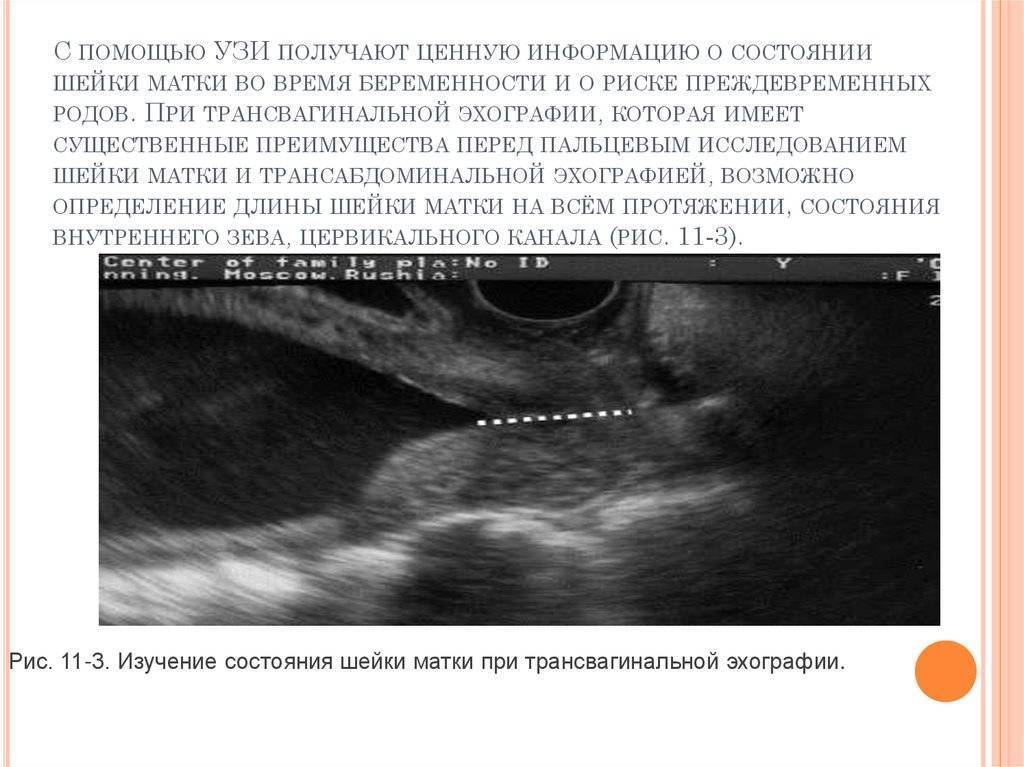 Расширение полости матки. Ультразвуковое исследование матки при беременности. Ультразвуковое исследование шейки матки УЗИ-цервикометрия. Шейка матки цервикометрия.