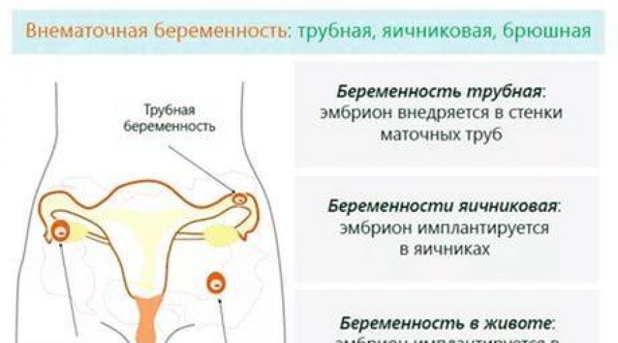 Внематочная беременность симптомы признаки на раннем сроке. Симптоматика внематочной беременности. Первые признаки внематочной беременности. Внематочная беременность симптомы. Внематочная беременность симптомы на ранних сроках.