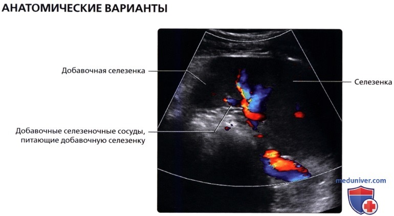 Добавочная селезенка у ребенка. Добавочная долька селезенки на УЗИ. Анатомия селезенки на УЗИ. Селезенка на УЗИ верхний и Нижний полюс.