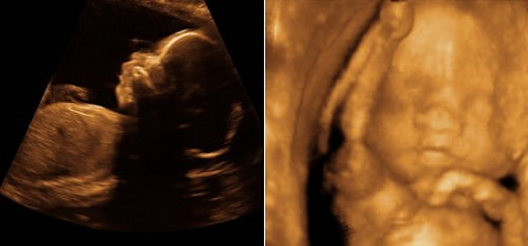 Фото ребенка в 25 недель беременности