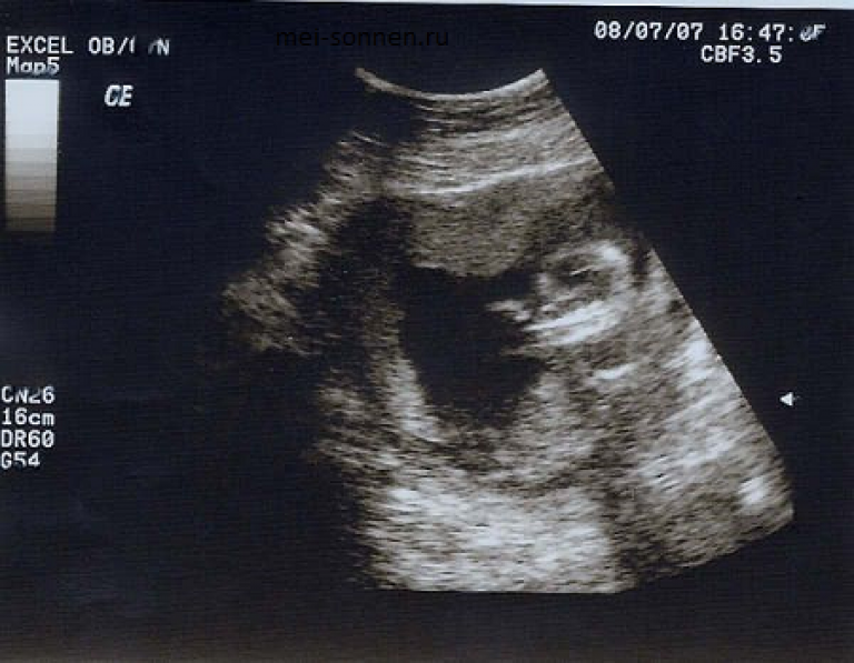 15 акушерских недель. Фото ребёнка в животе 12 13 14 неделя беременности от зачатия. У ребенка в 14 недель 1:68 тримасома 18. Если на соре 14 недель.