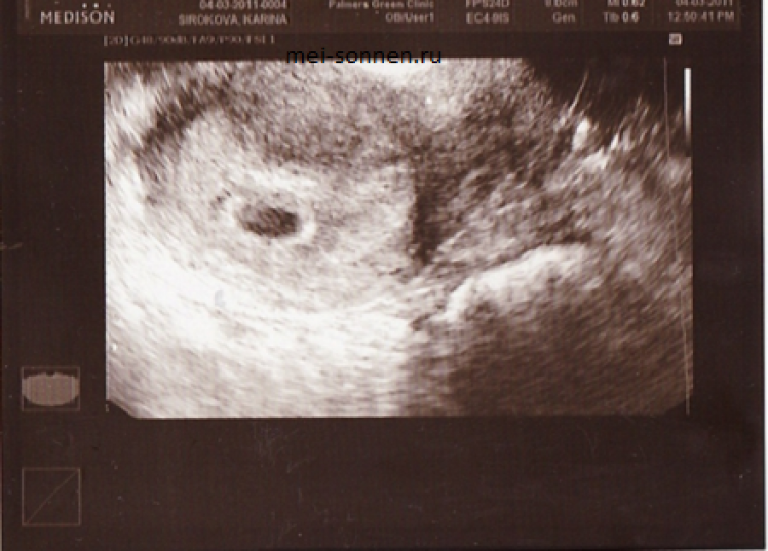Фото на 5 недели беременности как выглядит ребенок плода