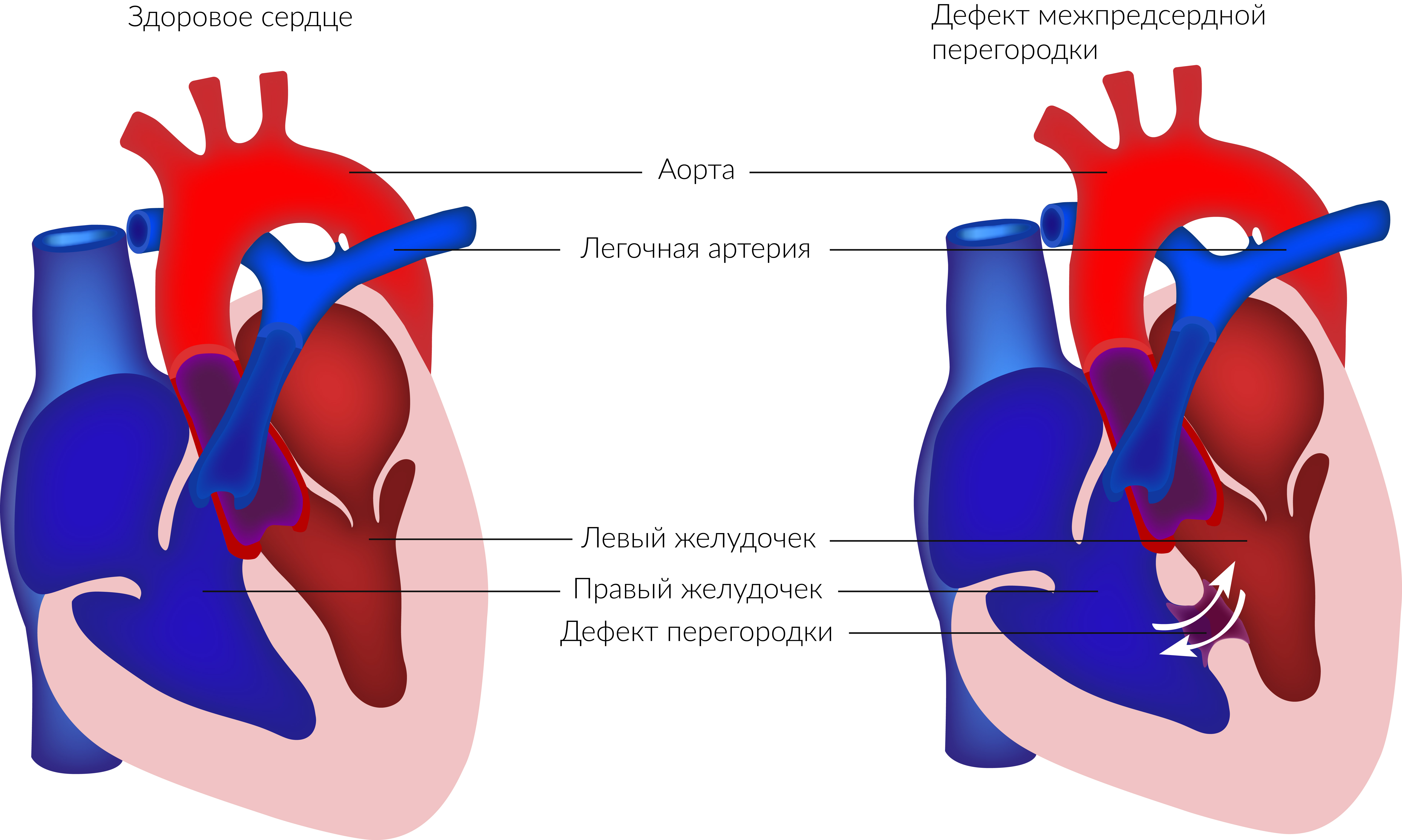 Врожденный порок сердца дефект межпредсердной перегородки