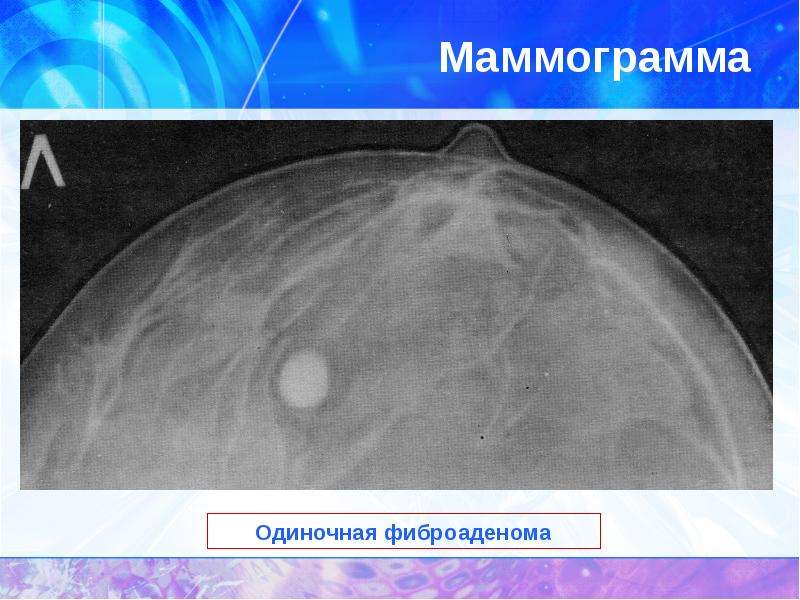 Закупорка протока молочной железы при кормлении фото