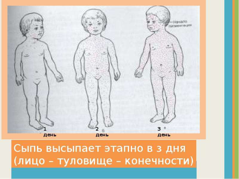 Виды сыпи у детей с картинками и название