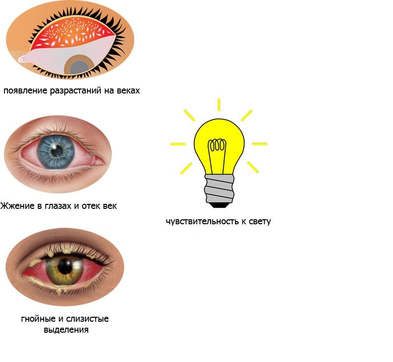 Конъюнктивит какие. Для бактериального конъюнктивита характерно:. Симптомы конъюнктивита глаз. Вирусный конъюнктивит симптомы.