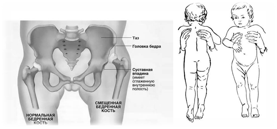 Дисплазия Суставов У Новорожденных Фото
