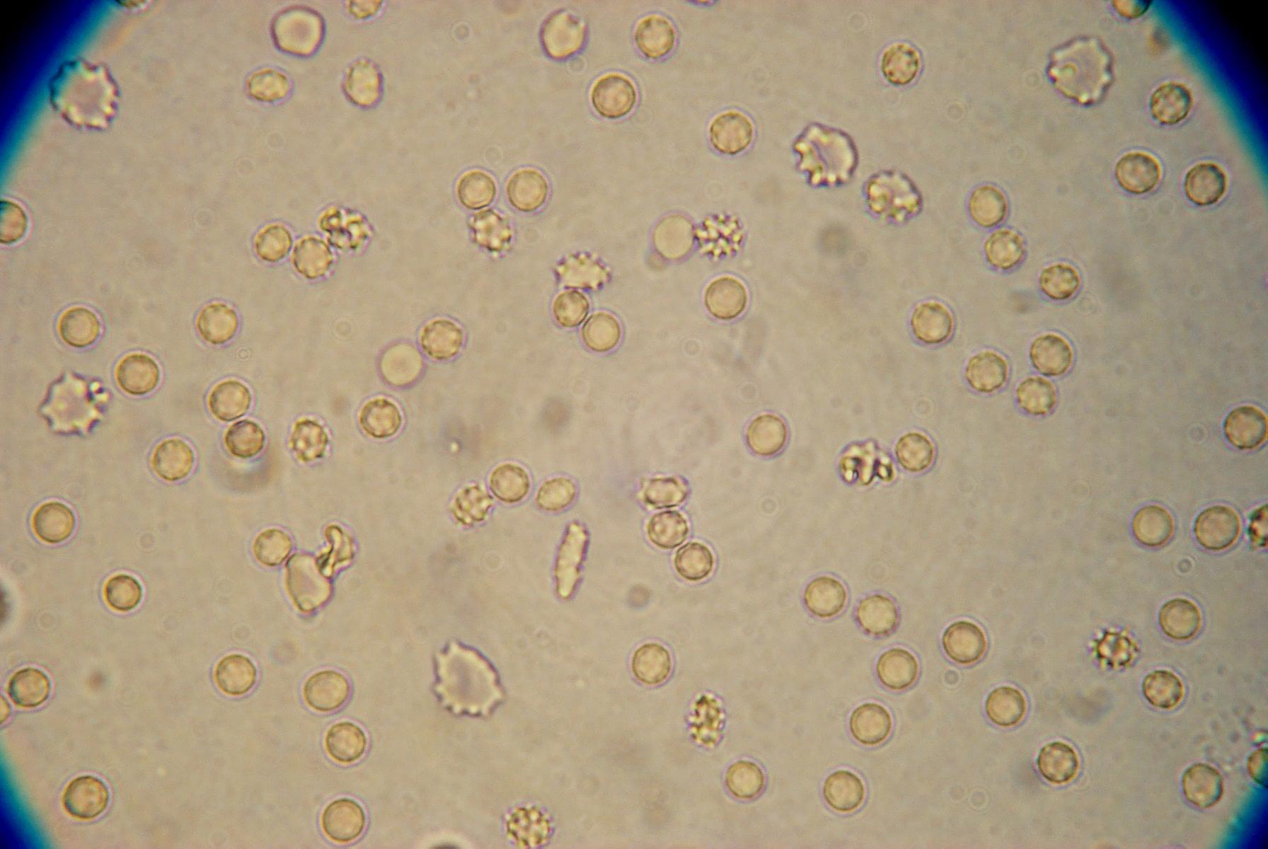 Эритроциты в моче микроскопия