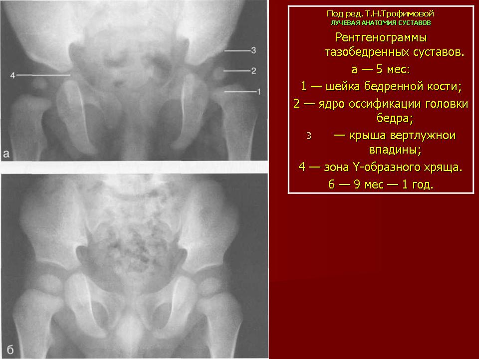 Ядро окостенения тазобедренного сустава фото