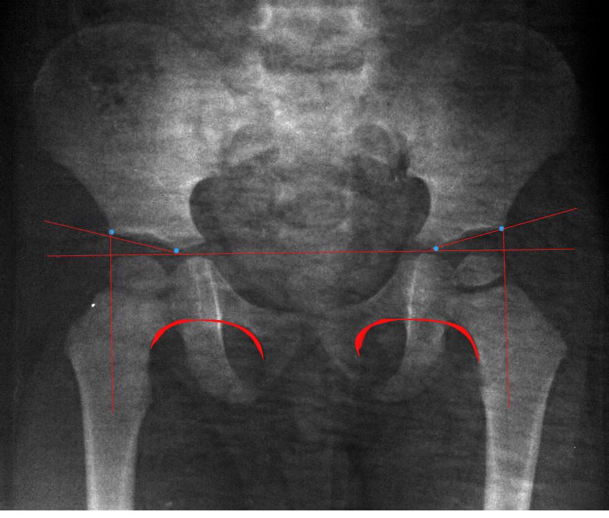 Дисплазия тазобедренных суставов у подростков фото