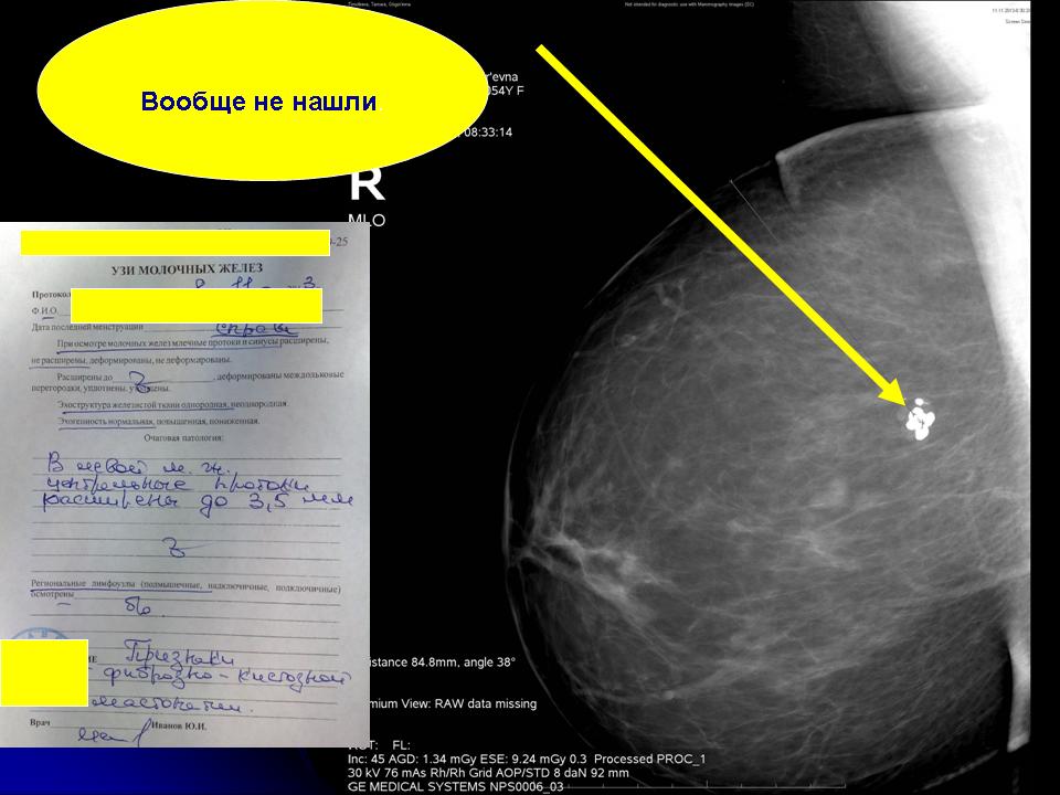 Округлые образования в молочной железе. Образование левой молочной железы. Очаговое образование правой молочной железы что это. Очаговое новообразование в молочной железе. Очаговое образование в грудной железе.