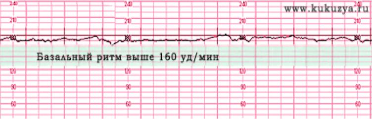 Сердцебиение плода на ктг