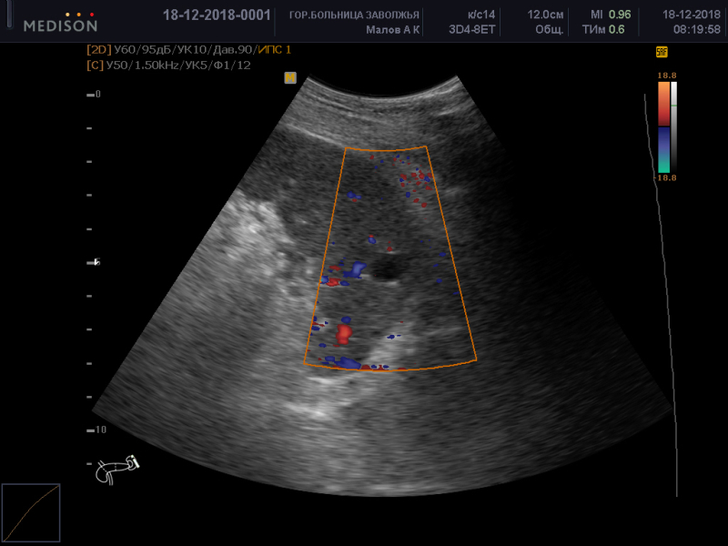 Узи с цдк брюшная. Миелолипома селезенки УЗИ. УЗИ селезенки с допплером. Спленомегалия селезенки УЗИ.