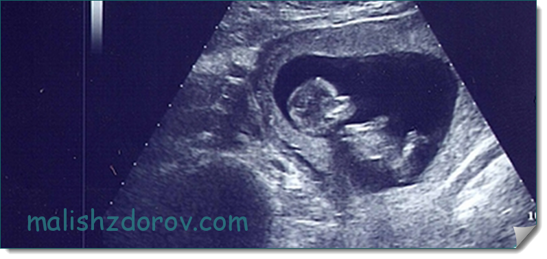 12 неделя ощущения. 12 Недель беременности фото плода на УЗИ. Снимок УЗИ на 12 неделе беременности пол. УЗИ 3 месяца беременности пол ребенка. Эмбрион 12 недель УЗИ.