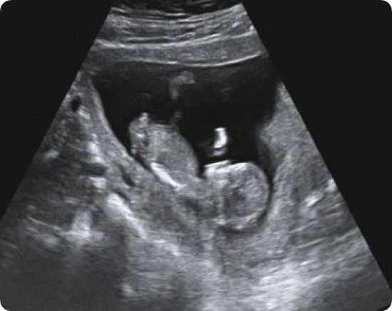 Ребенок 11 недель узи. УЗИ 11 недель беременности. УЗИ на 11 неделе беременности фото. УЗИ 11 недель беременности мальчик. Снимок УЗИ 11 недель беременности.