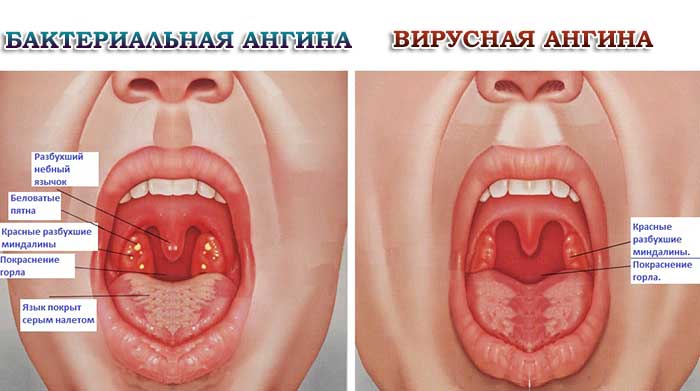 Ангина на начальной стадии – как определить по симптомам начальную стадию
