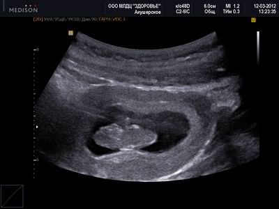 Фото плода 10 11 недель беременности – 10-11 неделя беременности: что происходит