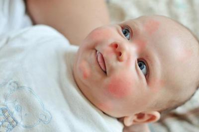 Крапивница у младенца – фото младенцев, симптомы и лечение болезни у новорожденных детей, а также профилактика сыпи у ребенка до года